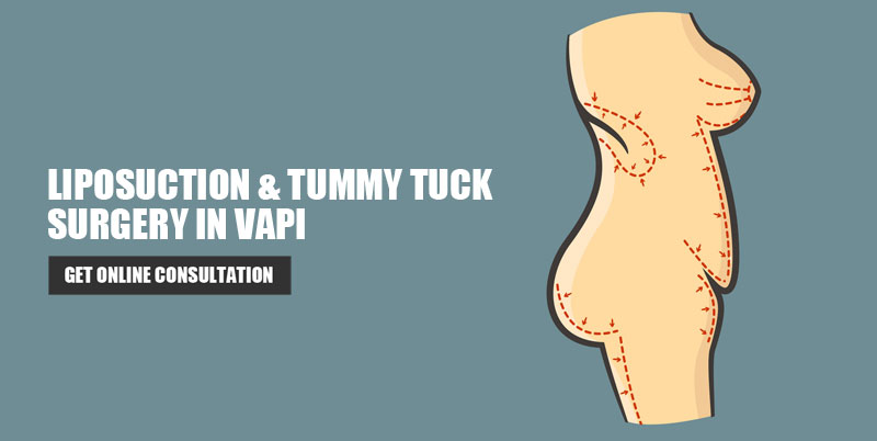 Liposuction Surgery in Vapi